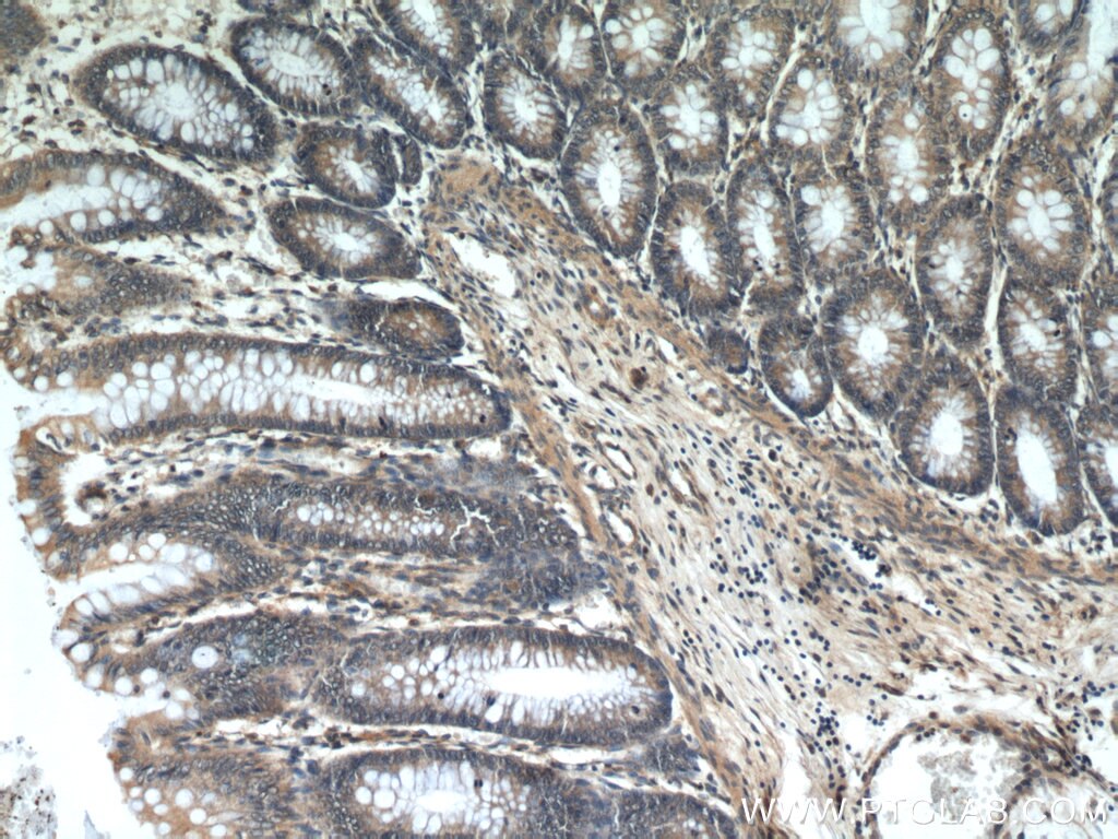 Immunohistochemistry (IHC) staining of human colon tissue using ITGB1BP1 Polyclonal antibody (12300-1-AP)