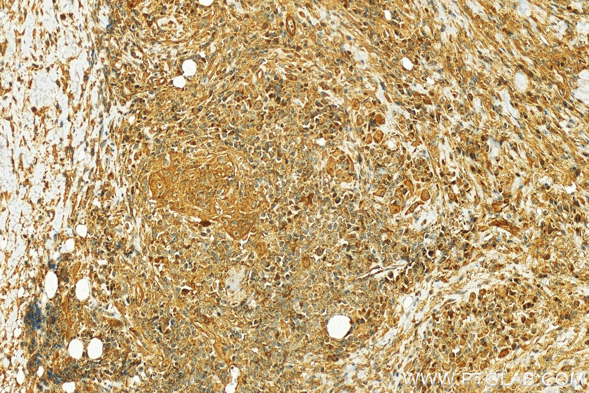 Immunohistochemistry (IHC) staining of human skin cancer tissue using Centromere protein R Polyclonal antibody (10743-1-AP)