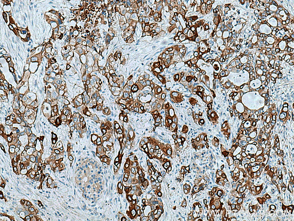 Immunohistochemistry (IHC) staining of human pancreas cancer tissue using Integrin Beta 4 Polyclonal antibody (21738-1-AP)