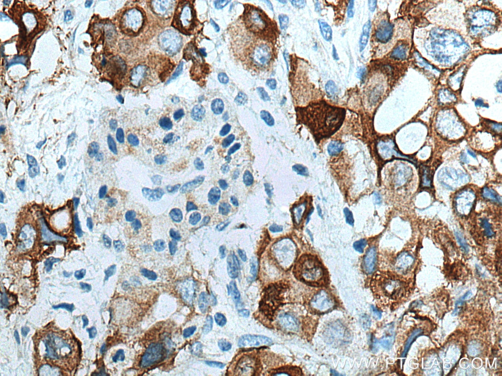 Immunohistochemistry (IHC) staining of human pancreas cancer tissue using Integrin Beta 4 Polyclonal antibody (21738-1-AP)