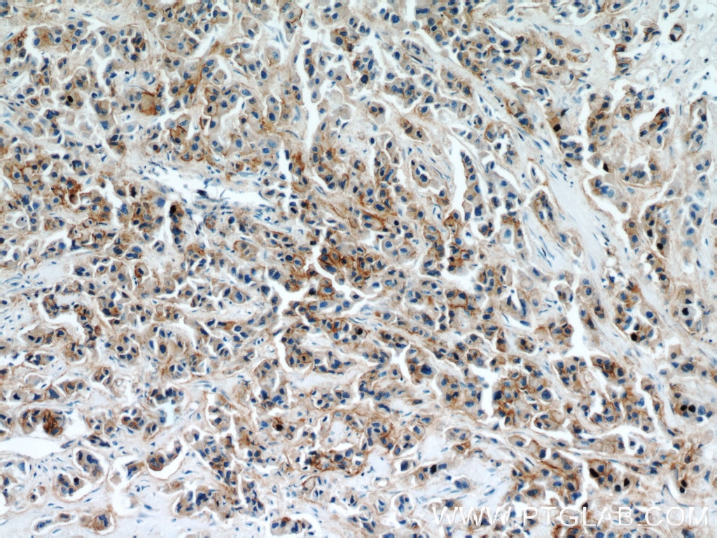 Immunohistochemistry (IHC) staining of human breast cancer tissue using Integrin Beta 4 Polyclonal antibody (21738-1-AP)