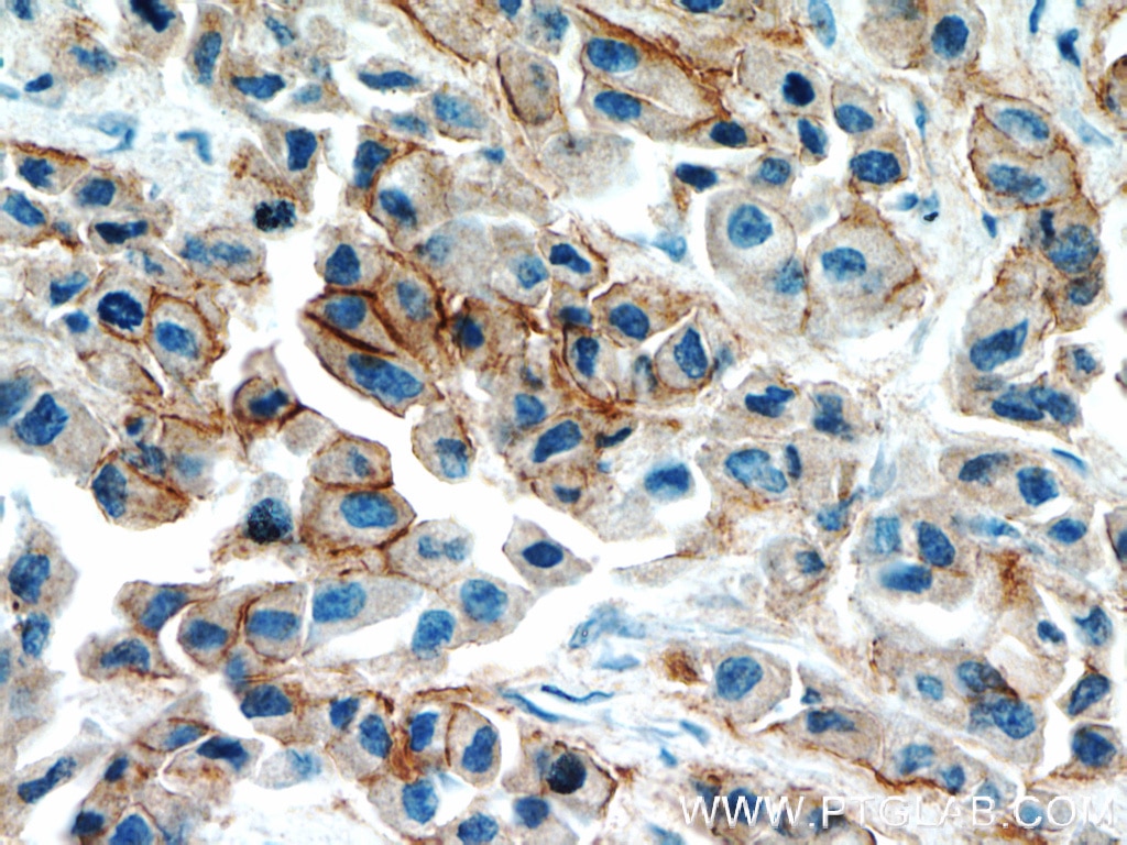 Immunohistochemistry (IHC) staining of human breast cancer tissue using Integrin Beta 4 Polyclonal antibody (21738-1-AP)