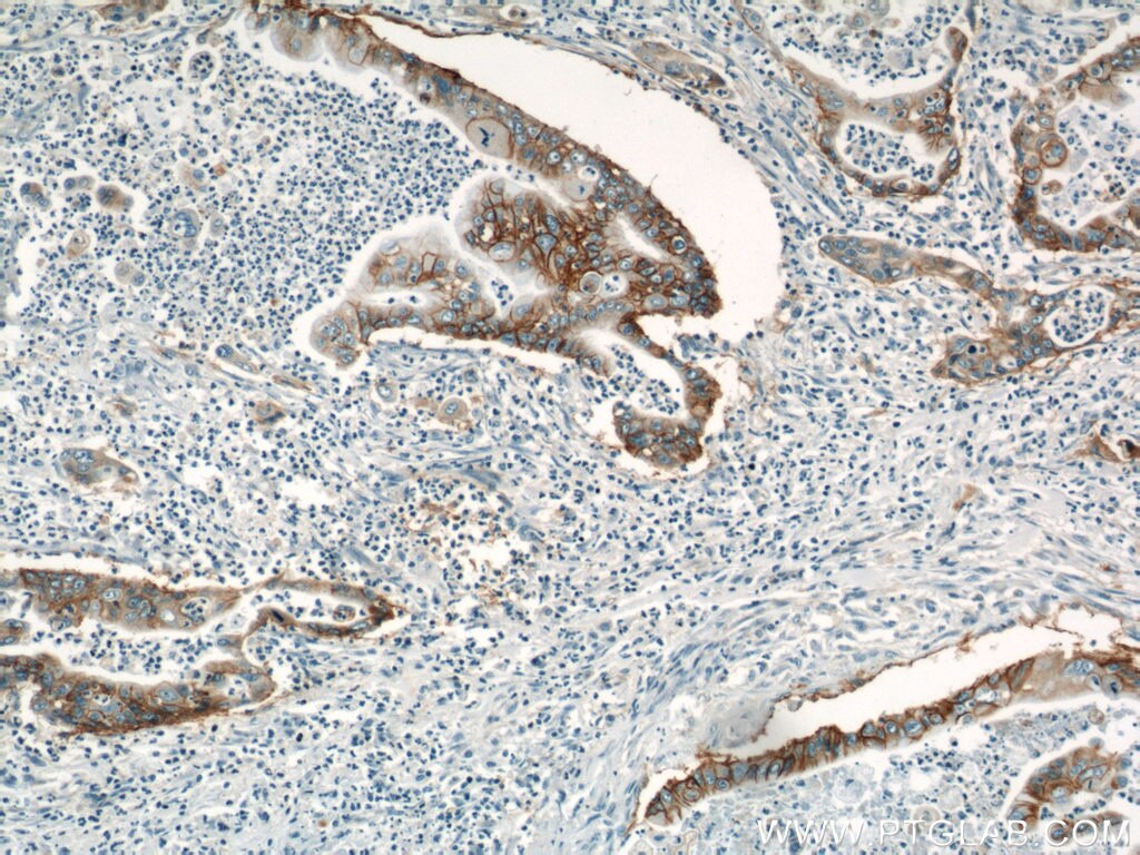 Immunohistochemistry (IHC) staining of human pancreas cancer tissue using Integrin Beta 4 Polyclonal antibody (21738-1-AP)