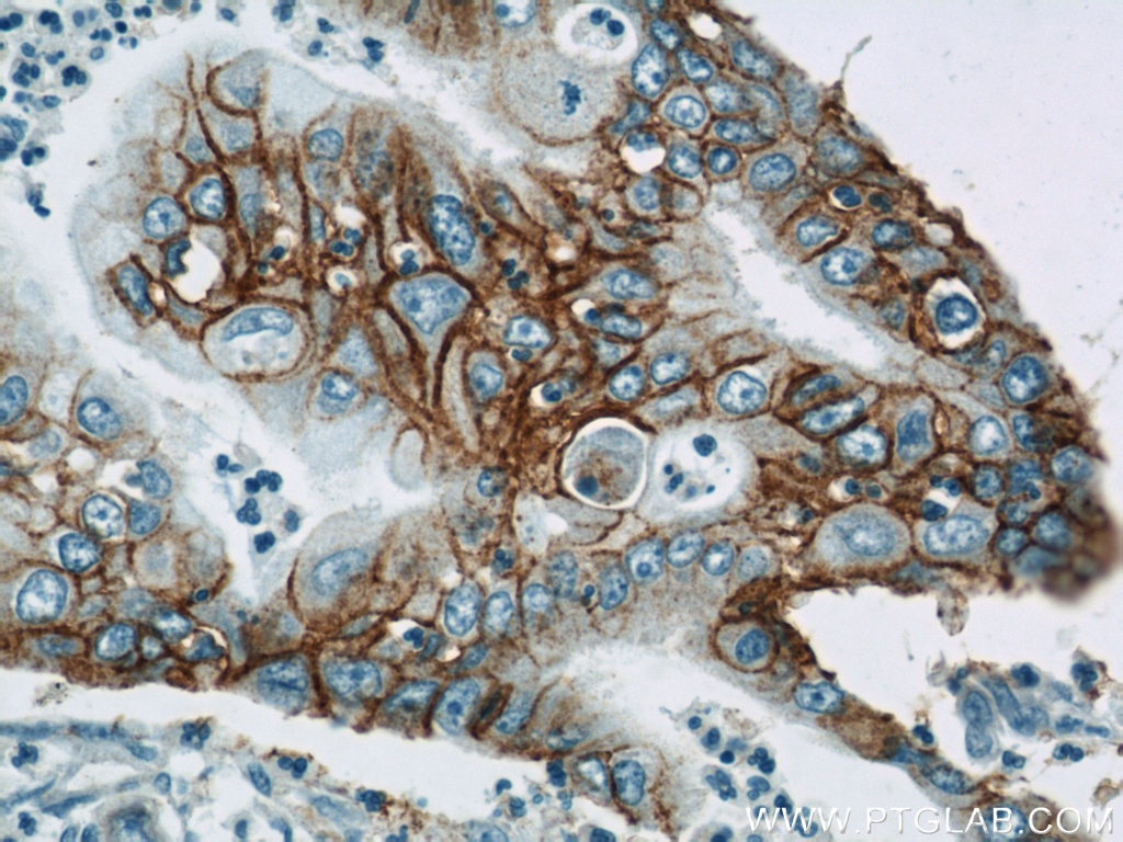 Immunohistochemistry (IHC) staining of human pancreas cancer tissue using Integrin Beta 4 Polyclonal antibody (21738-1-AP)
