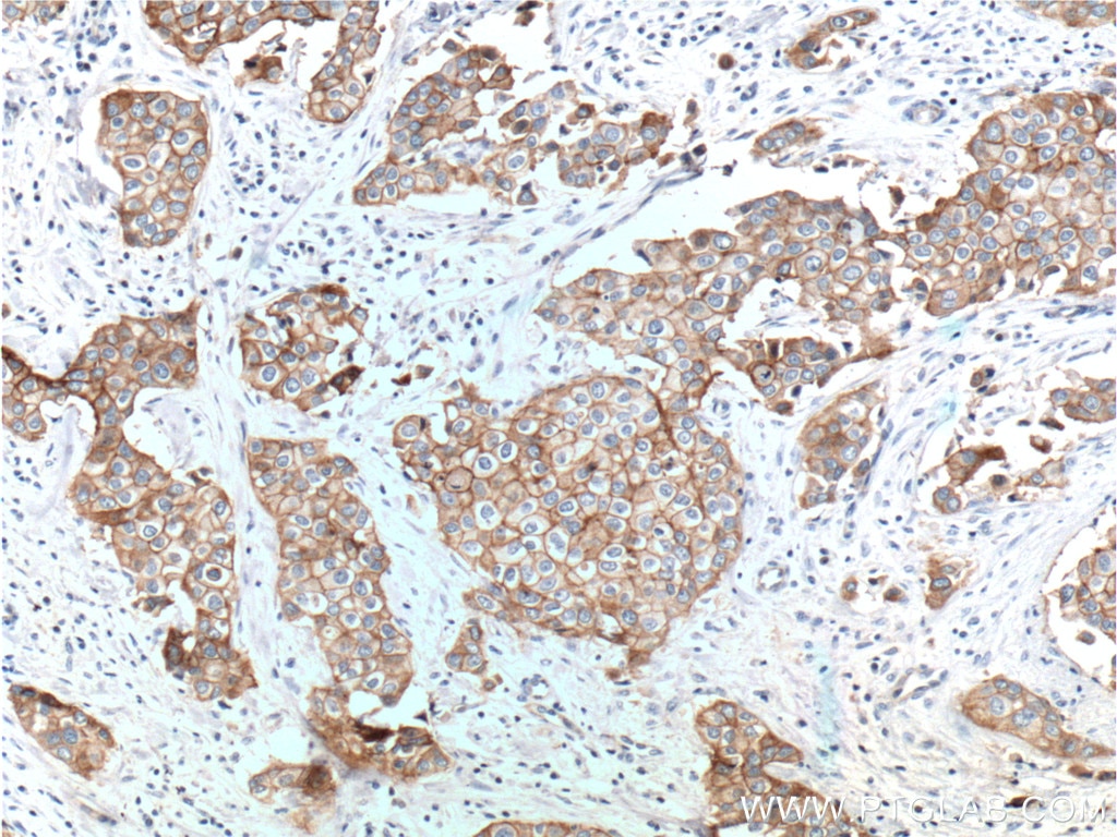 Immunohistochemistry (IHC) staining of human breast cancer tissue using Integrin Beta 4 Polyclonal antibody (25277-1-AP)