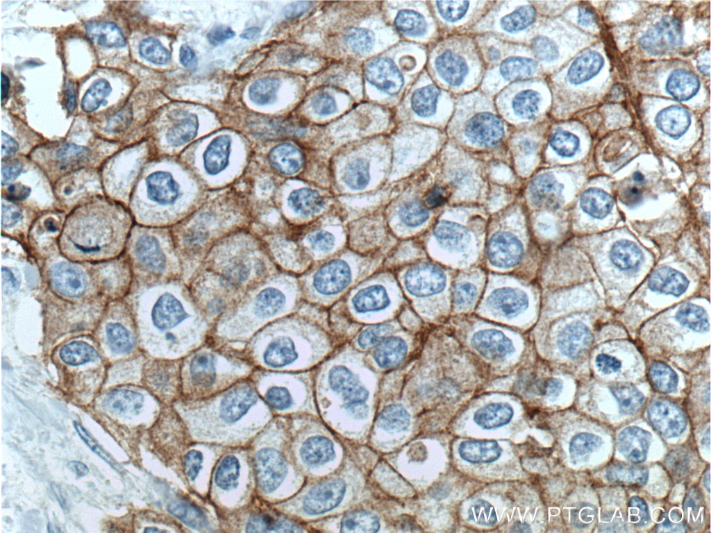 IHC staining of human breast cancer using 25277-1-AP