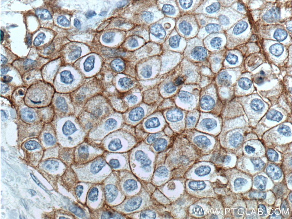 Immunohistochemistry (IHC) staining of human breast cancer tissue using Integrin Beta 4 Polyclonal antibody (25277-1-AP)