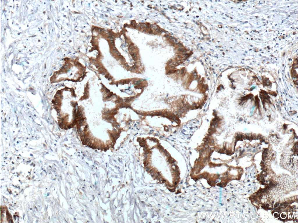 Immunohistochemistry (IHC) staining of human pancreas cancer tissue using Integrin Beta 4 Polyclonal antibody (25277-1-AP)