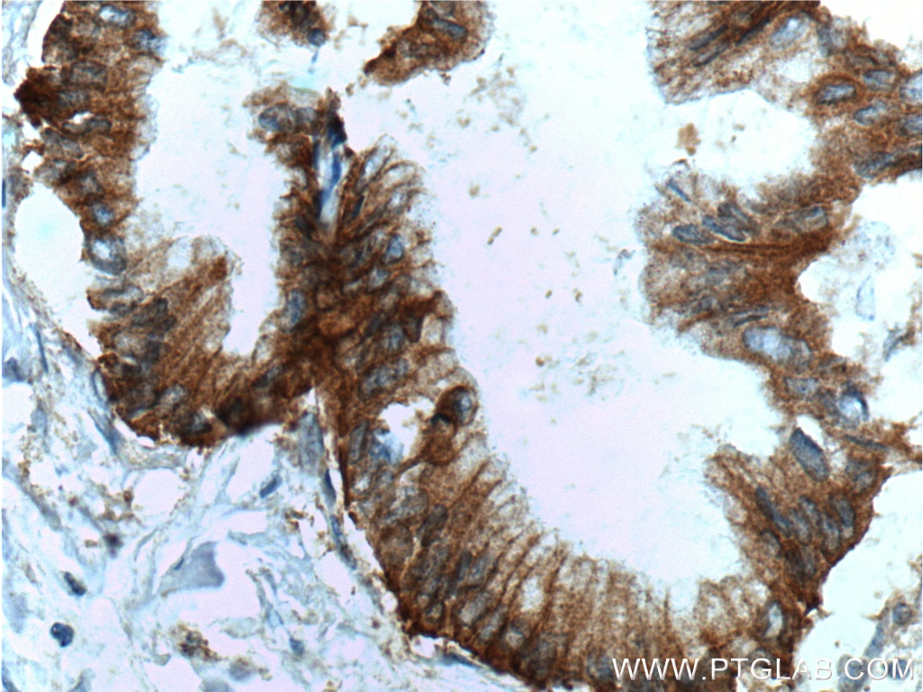 Immunohistochemistry (IHC) staining of human pancreas cancer tissue using Integrin Beta 4 Polyclonal antibody (25277-1-AP)