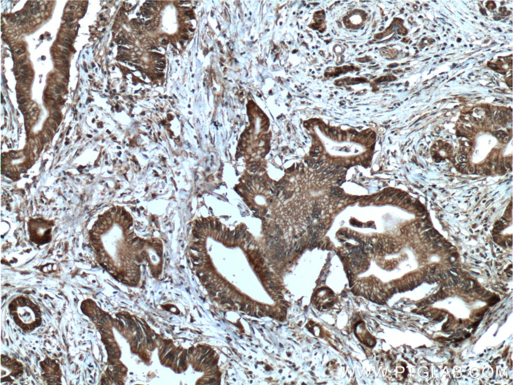 Immunohistochemistry (IHC) staining of human pancreas cancer tissue using Integrin Beta 6 Polyclonal antibody (21703-1-AP)
