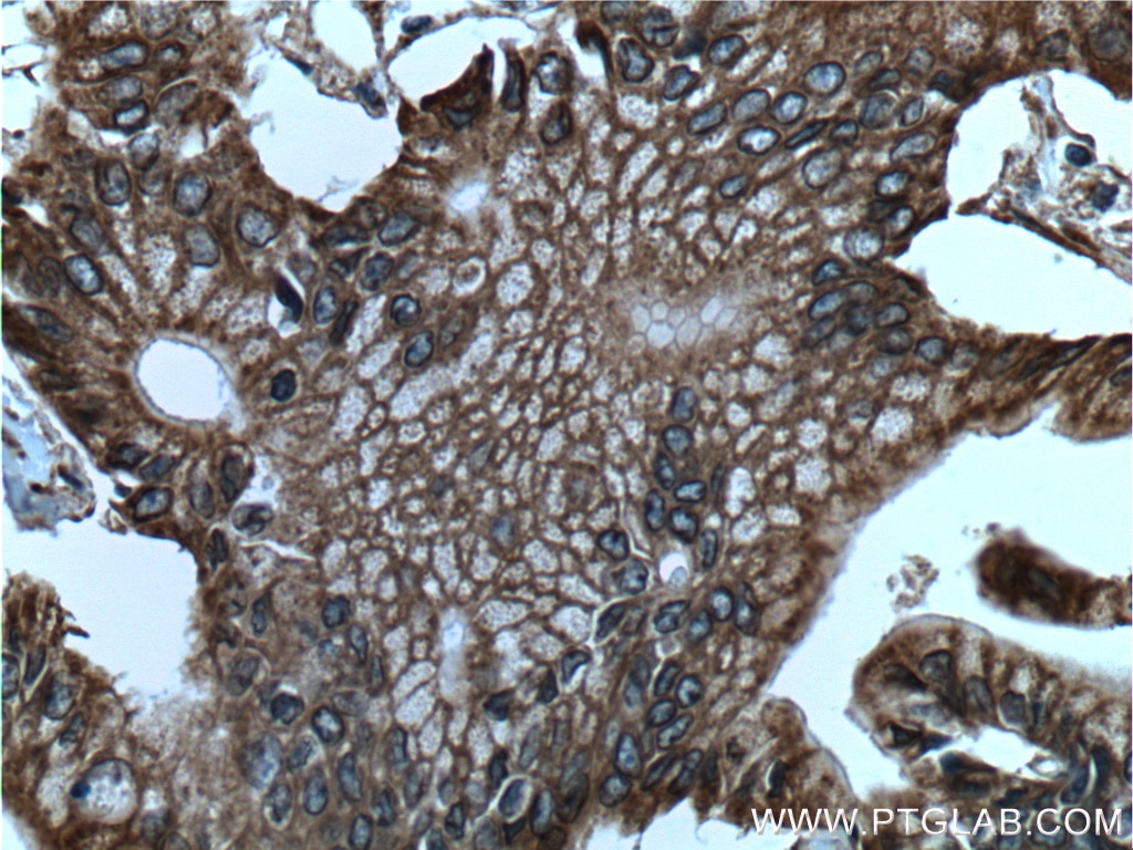 Immunohistochemistry (IHC) staining of human pancreas cancer tissue using Integrin Beta 6 Polyclonal antibody (21703-1-AP)