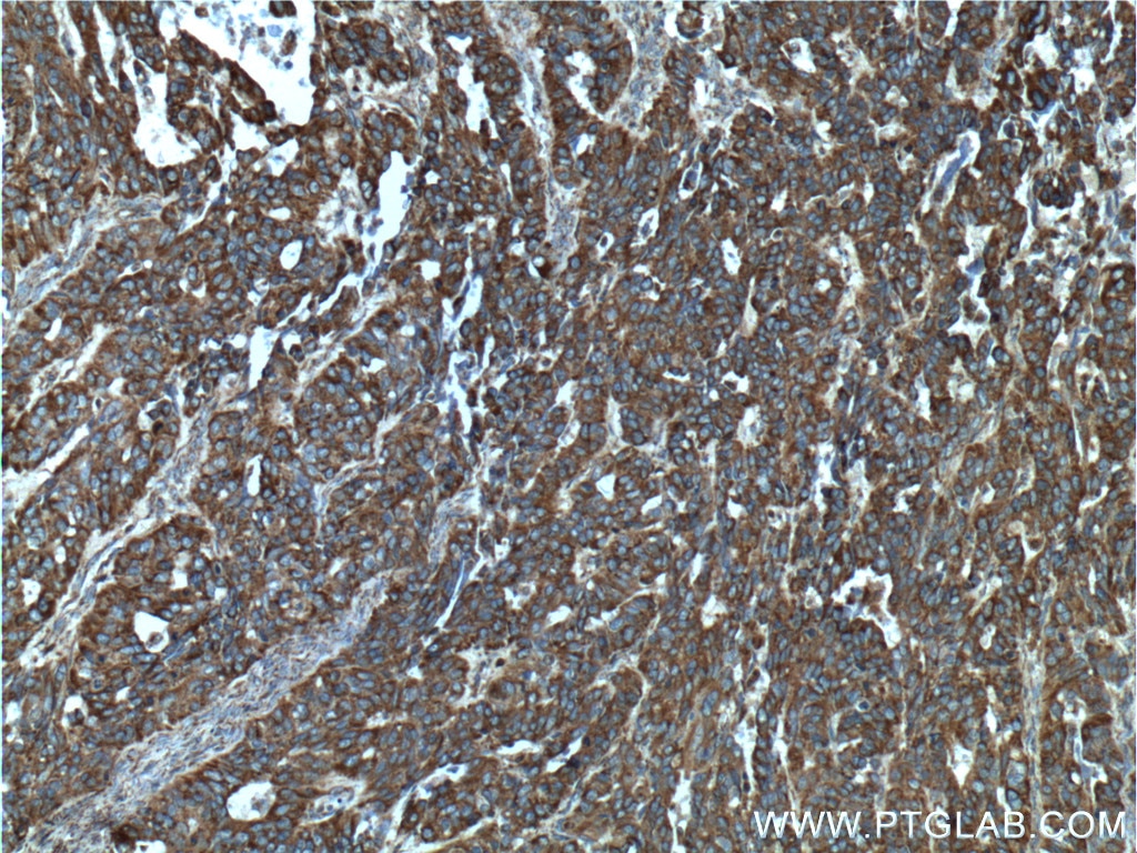 Immunohistochemistry (IHC) staining of human ovary tumor tissue using Integrin Beta 6 Polyclonal antibody (21703-1-AP)