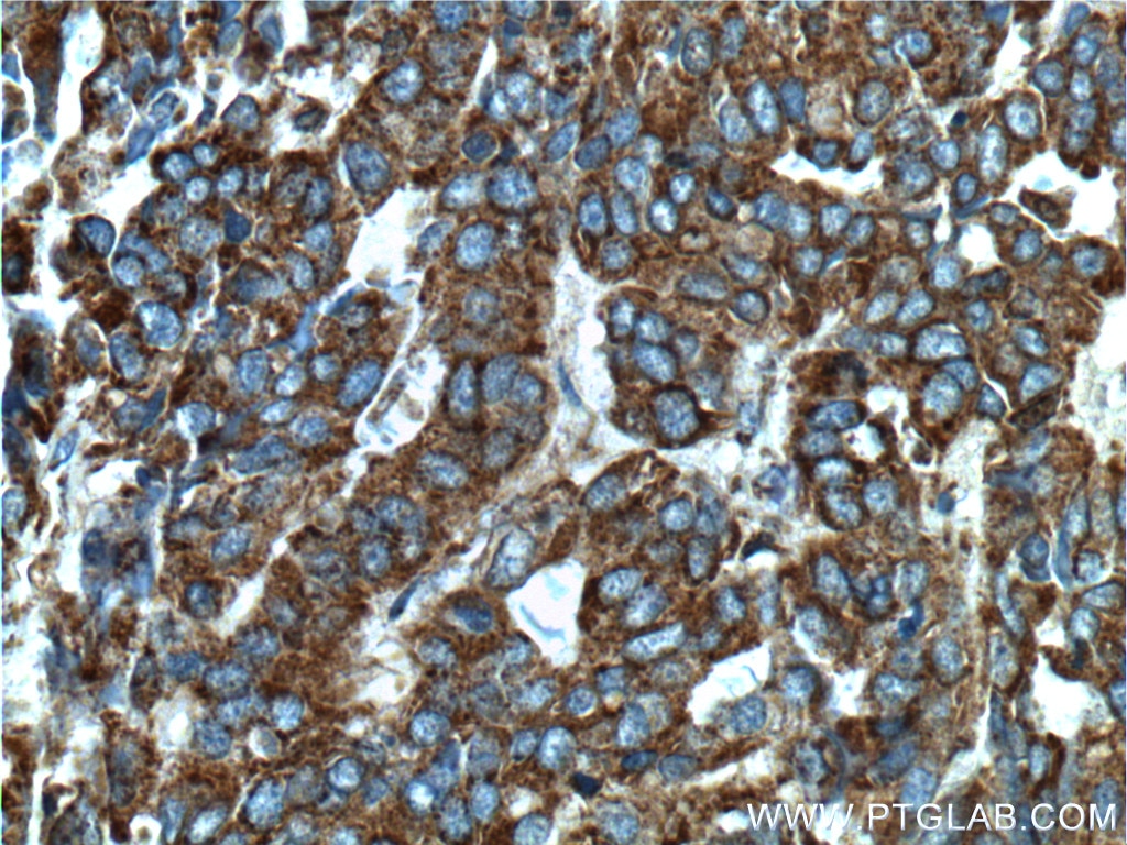 Immunohistochemistry (IHC) staining of human ovary tumor tissue using Integrin Beta 6 Polyclonal antibody (21703-1-AP)