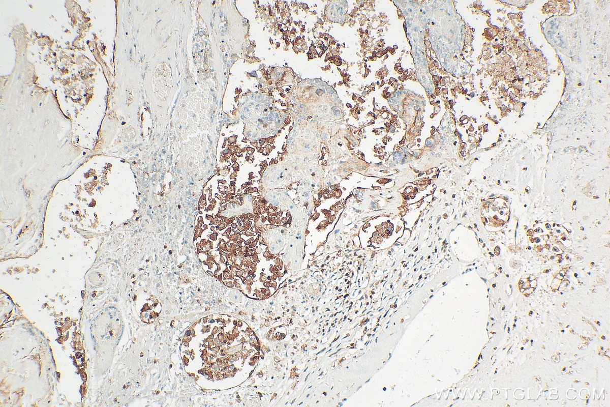 Immunohistochemistry (IHC) staining of human ovary tumor tissue using Integrin Beta 6 Polyclonal antibody (21703-1-AP)