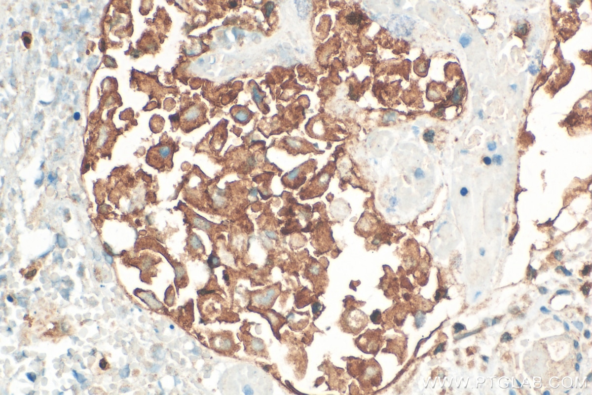 Immunohistochemistry (IHC) staining of human ovary tumor tissue using Integrin Beta 6 Polyclonal antibody (21703-1-AP)