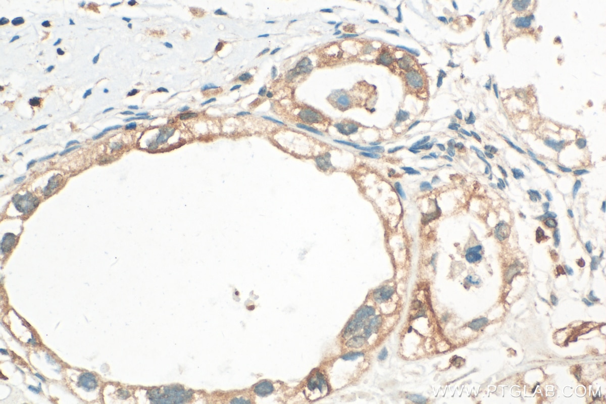 Immunohistochemistry (IHC) staining of human ovary tumor tissue using Integrin Beta 6 Polyclonal antibody (21703-1-AP)