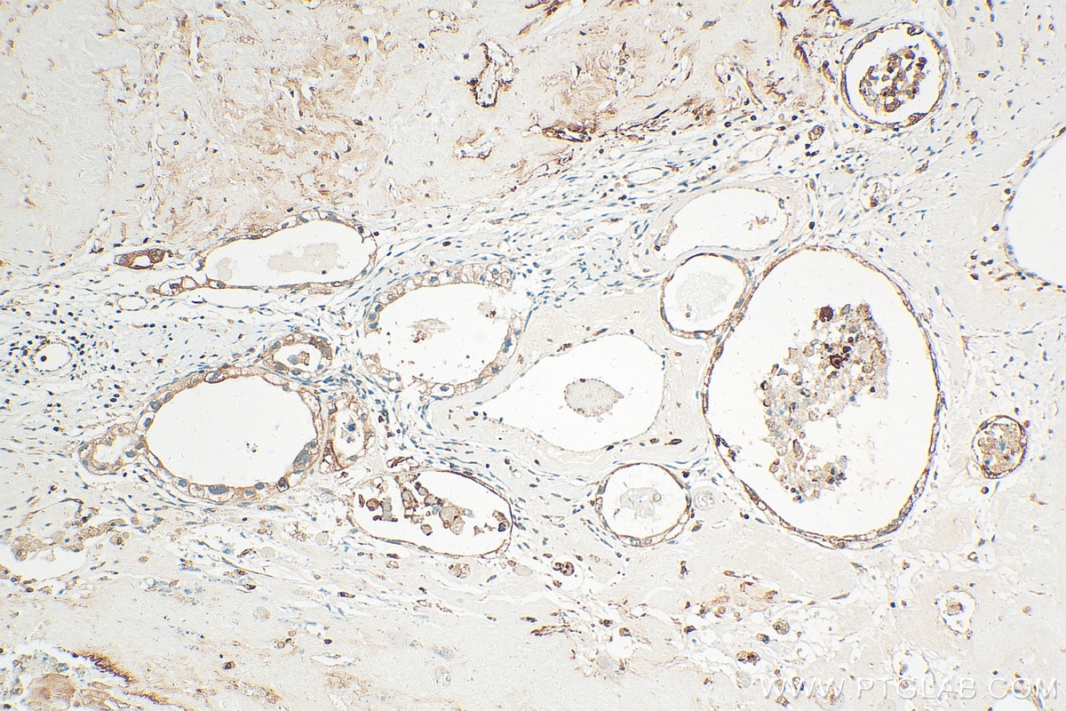 Immunohistochemistry (IHC) staining of human ovary tumor tissue using Integrin Beta 6 Polyclonal antibody (21703-1-AP)