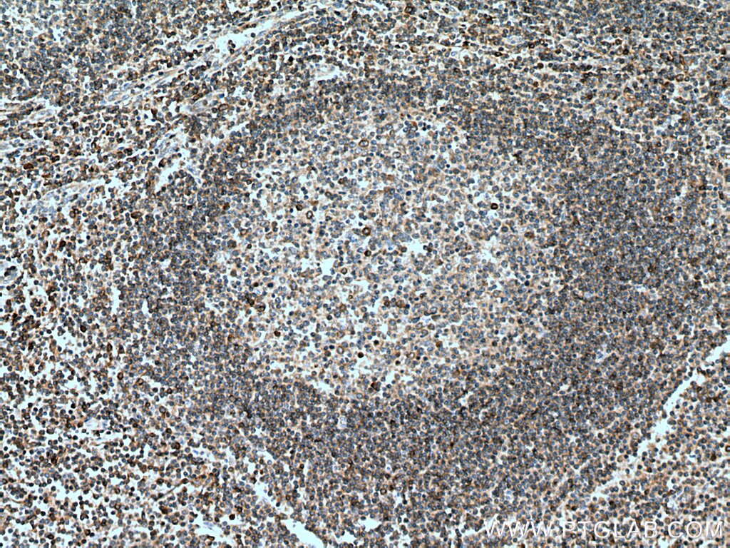 IHC staining of human tonsillitis using 11328-1-AP