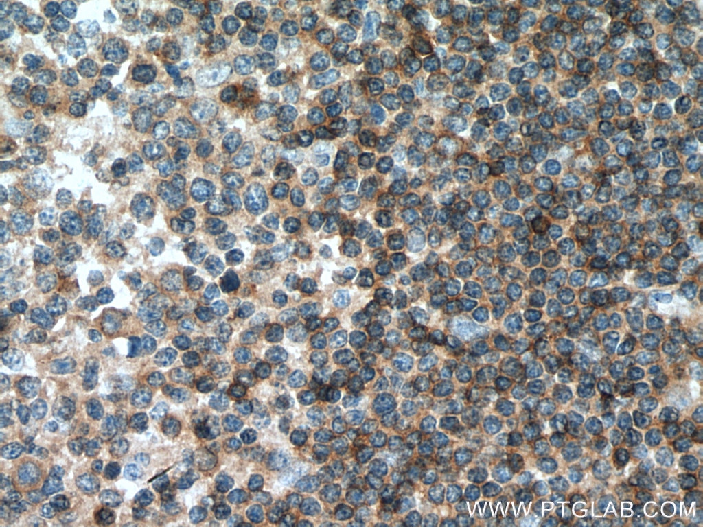 Immunohistochemistry (IHC) staining of human tonsillitis tissue using Integrin Beta 7 Polyclonal antibody (11328-1-AP)