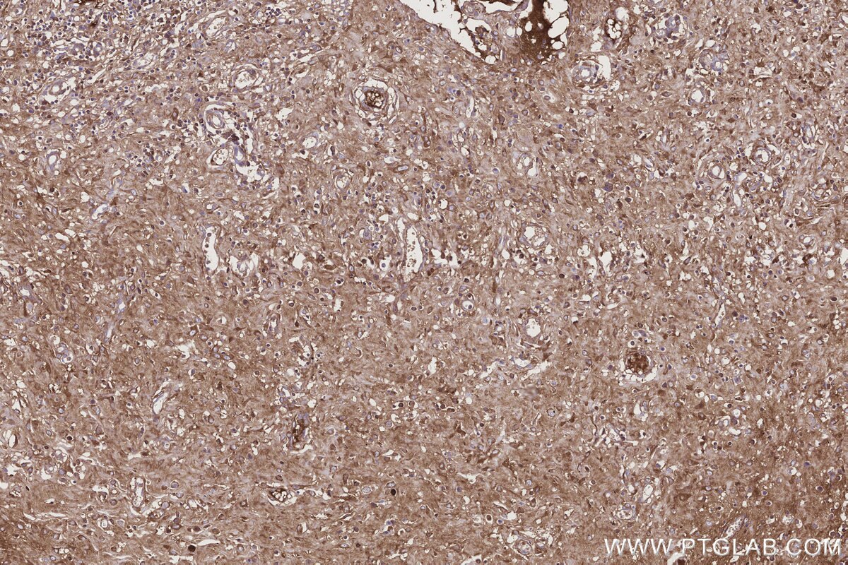 IHC staining of human colon cancer using 21141-1-AP Immunohistochemistry (IHC) staining of human colon cancer tissue using ITIH1 Polyclonal antibody (21141-1-AP)