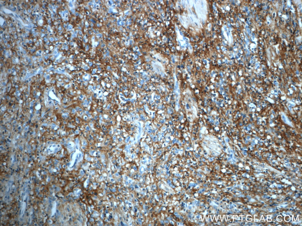Immunohistochemistry (IHC) staining of human stomach cancer tissue using ITIH3 Polyclonal antibody (21247-1-AP)