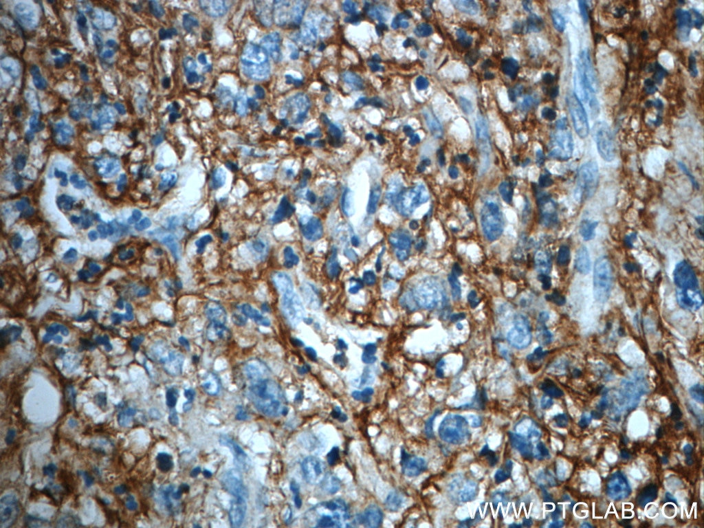 Immunohistochemistry (IHC) staining of human stomach cancer tissue using ITIH3 Polyclonal antibody (21247-1-AP)