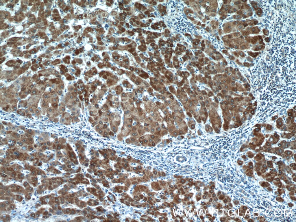 Immunohistochemistry (IHC) staining of human hepatocirrhosis tissue using ITIH4 Polyclonal antibody (24069-1-AP)