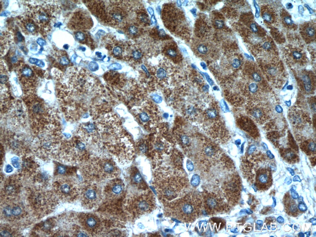 Immunohistochemistry (IHC) staining of human hepatocirrhosis tissue using ITIH4 Polyclonal antibody (24069-1-AP)