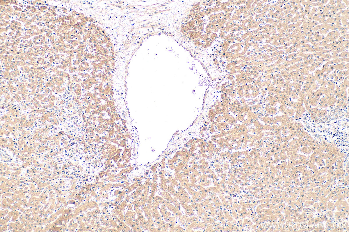 Immunohistochemistry (IHC) staining of human hepatocirrhosis tissue using ITIH4 Polyclonal antibody (24069-1-AP)
