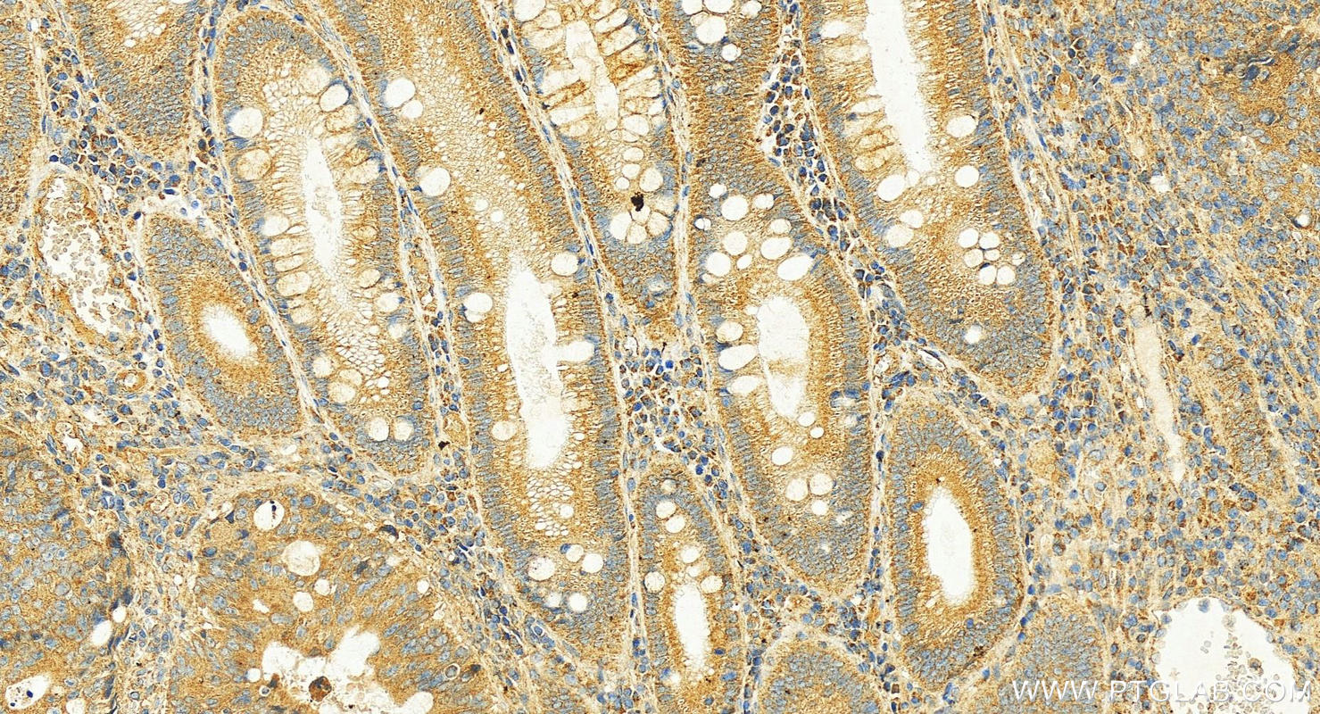 Immunohistochemistry (IHC) staining of human colon cancer tissue using ITLN2 Polyclonal antibody (18815-1-AP)