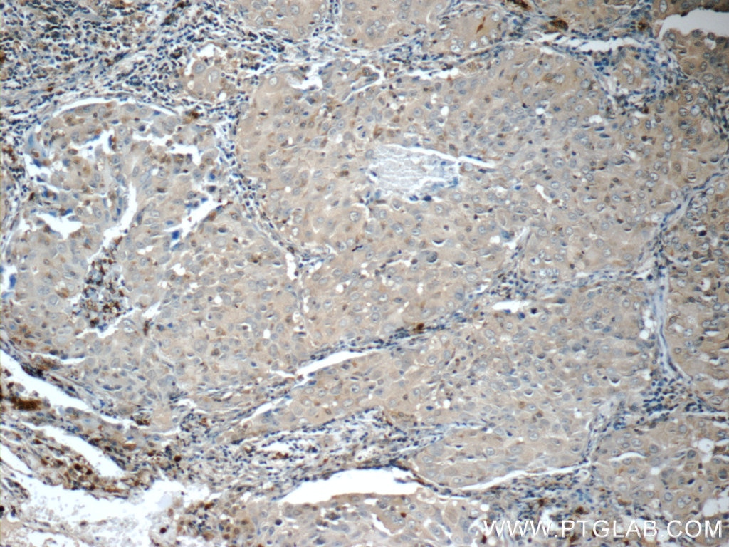 Immunohistochemistry (IHC) staining of human lung cancer tissue using ITPA Polyclonal antibody (16134-1-AP)