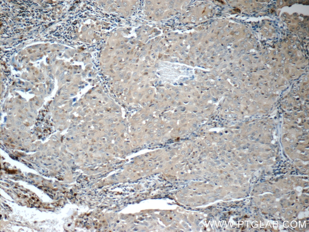 IHC staining of human lung cancer using 16134-1-AP