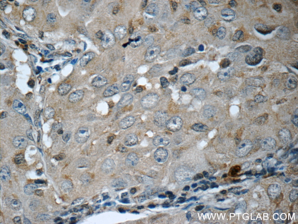 IHC staining of human lung cancer using 16134-1-AP