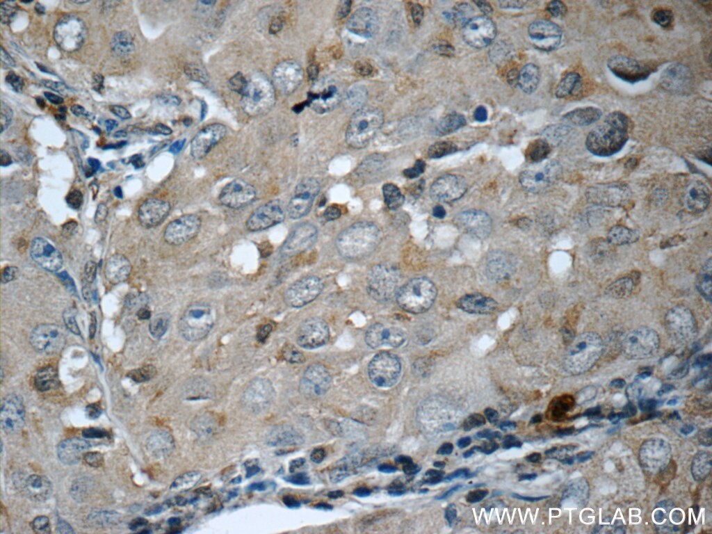 Immunohistochemistry (IHC) staining of human lung cancer tissue using ITPA Polyclonal antibody (16134-1-AP)