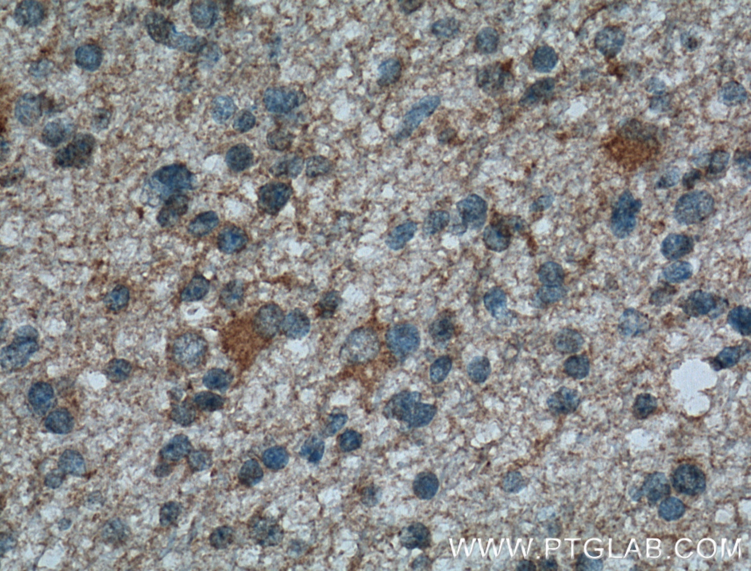 Immunohistochemistry (IHC) staining of human gliomas tissue using ITPKA Polyclonal antibody (14270-1-AP)