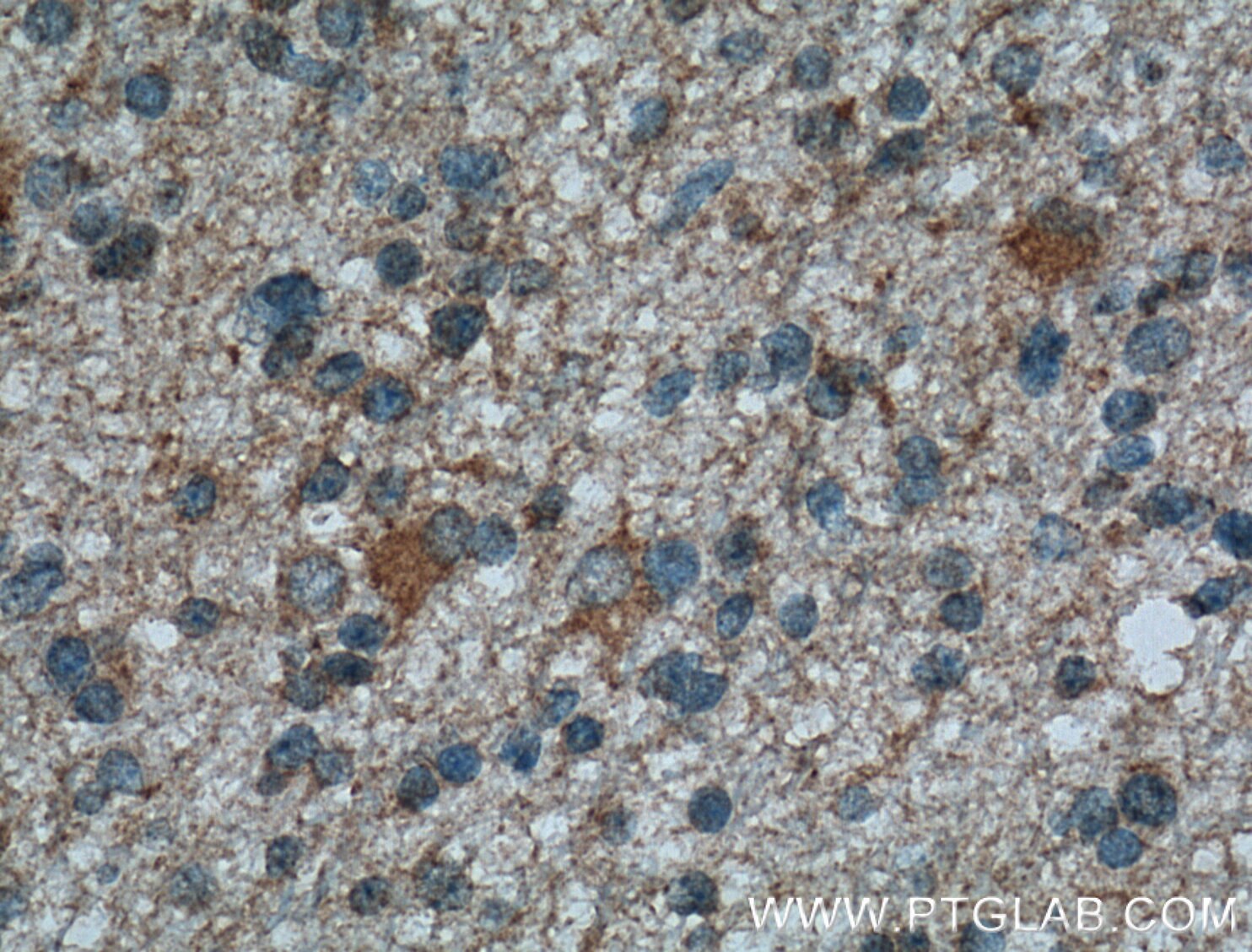 IHC staining of human gliomas using 14270-1-AP