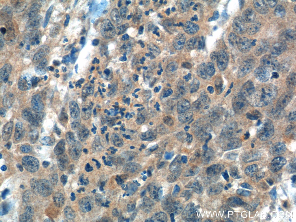 Immunohistochemistry (IHC) staining of human cervical cancer tissue using ITPKB Polyclonal antibody (12816-1-AP)