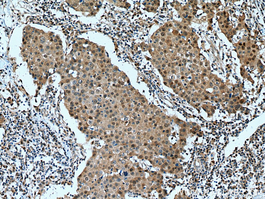 Immunohistochemistry (IHC) staining of human breast cancer tissue using ITPKC Polyclonal antibody (14267-1-AP)