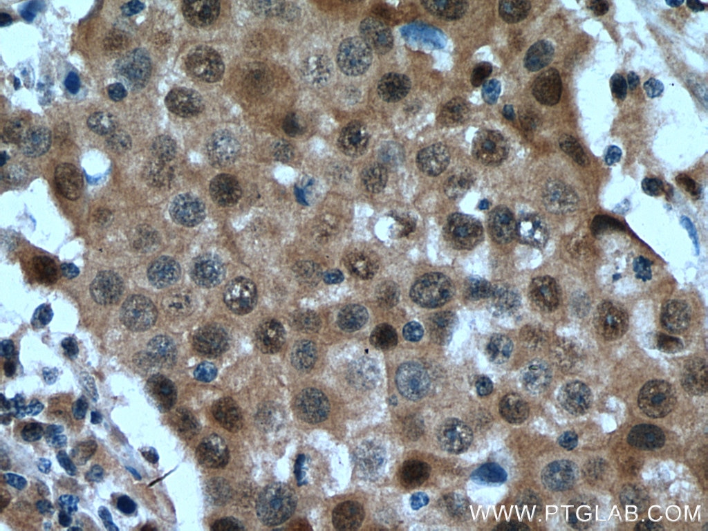 Immunohistochemistry (IHC) staining of human breast cancer tissue using ITPKC Polyclonal antibody (14267-1-AP)