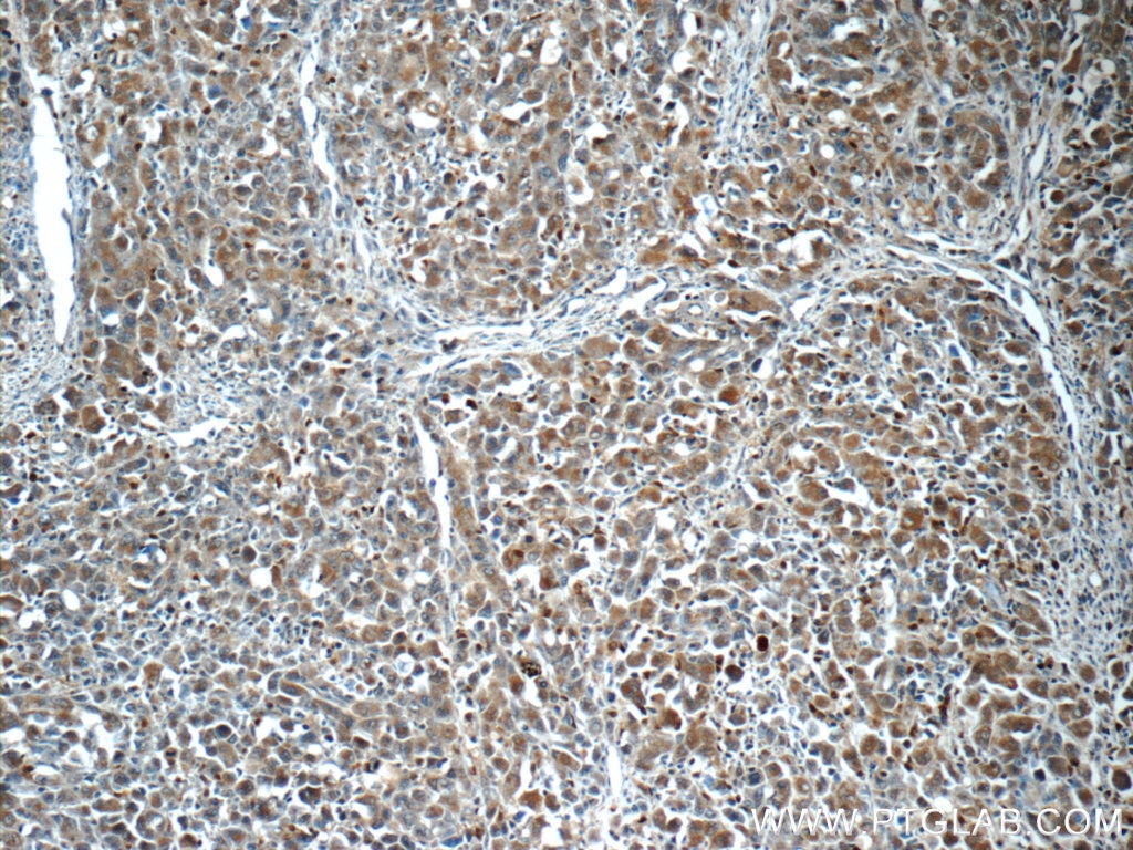 Immunohistochemistry (IHC) staining of human lymphoma tissue using ITPKC Polyclonal antibody (14267-1-AP)