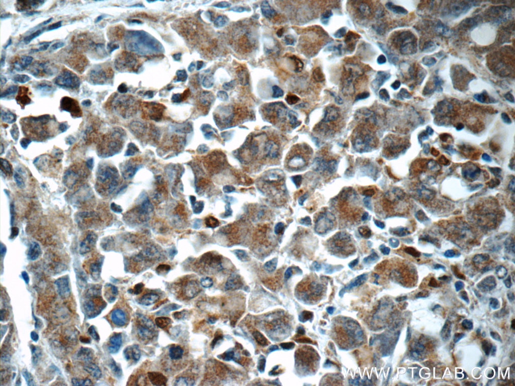 Immunohistochemistry (IHC) staining of human lymphoma tissue using ITPKC Polyclonal antibody (14267-1-AP)