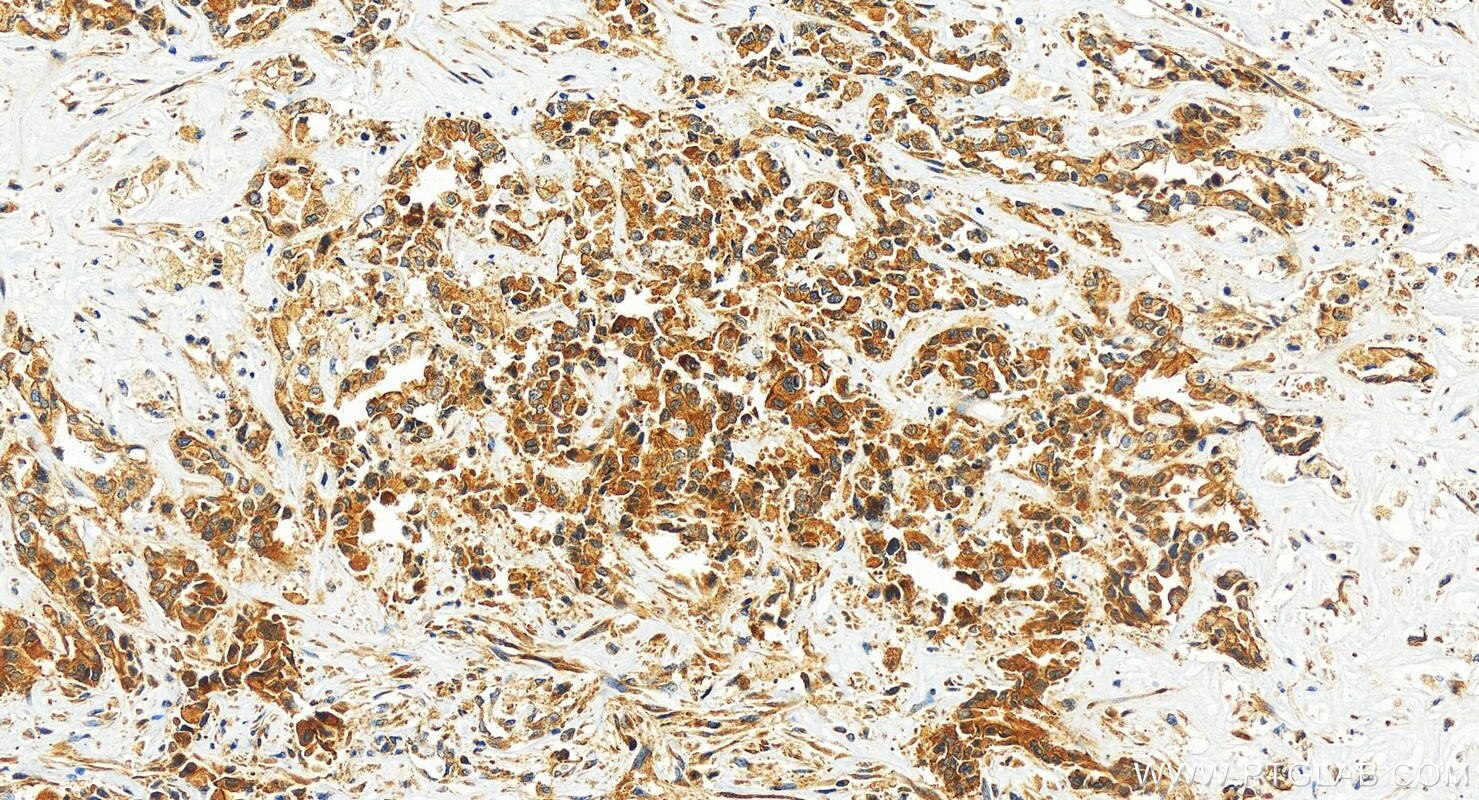 Immunohistochemistry (IHC) staining of human intrahepatic cholangiocarcinoma tissue using Intersectin 1 Polyclonal antibody (21862-1-AP)
