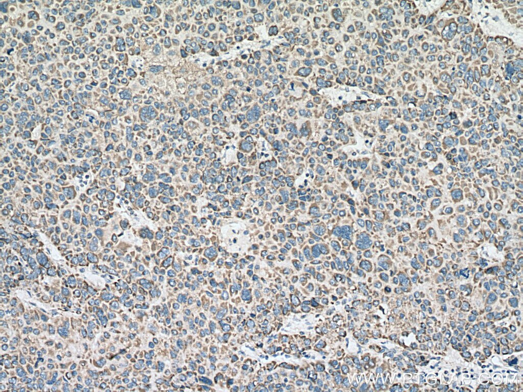 IHC staining of human liver cancer using 10822-1-AP