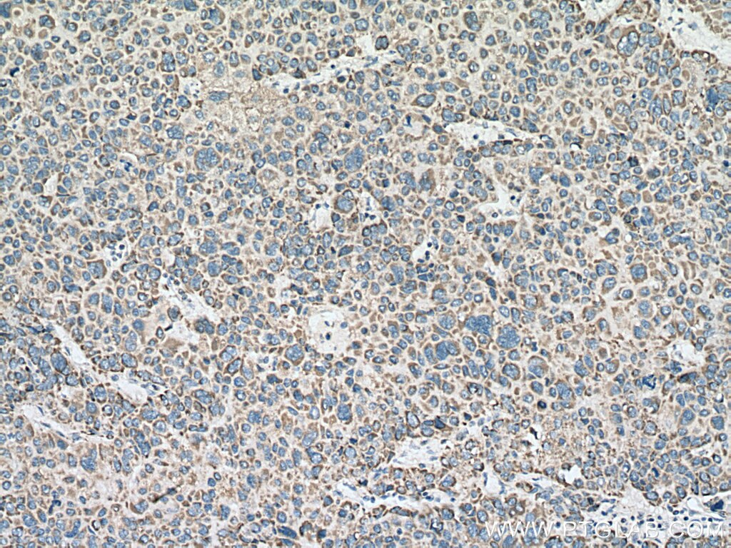 Immunohistochemistry (IHC) staining of human liver cancer tissue using IVD Polyclonal antibody (10822-1-AP)