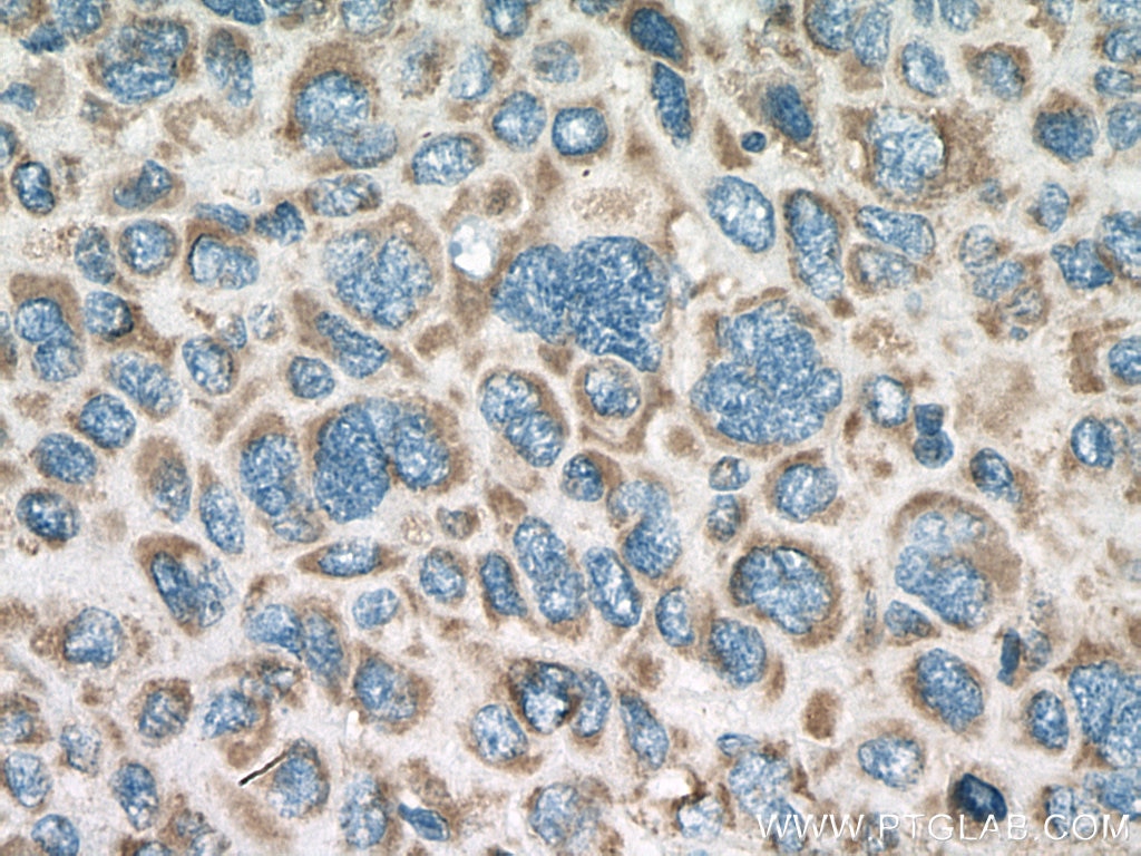 Immunohistochemistry (IHC) staining of human liver cancer tissue using IVD Polyclonal antibody (10822-1-AP)