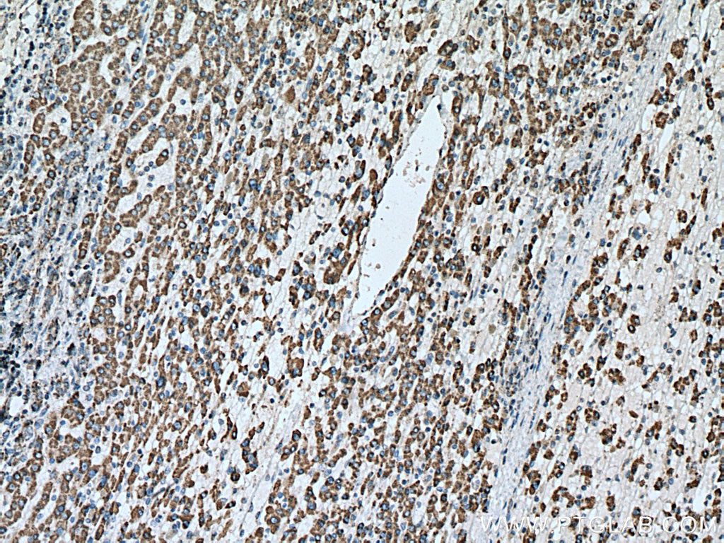 Immunohistochemistry (IHC) staining of human liver cancer tissue using IVD Polyclonal antibody (10822-1-AP)