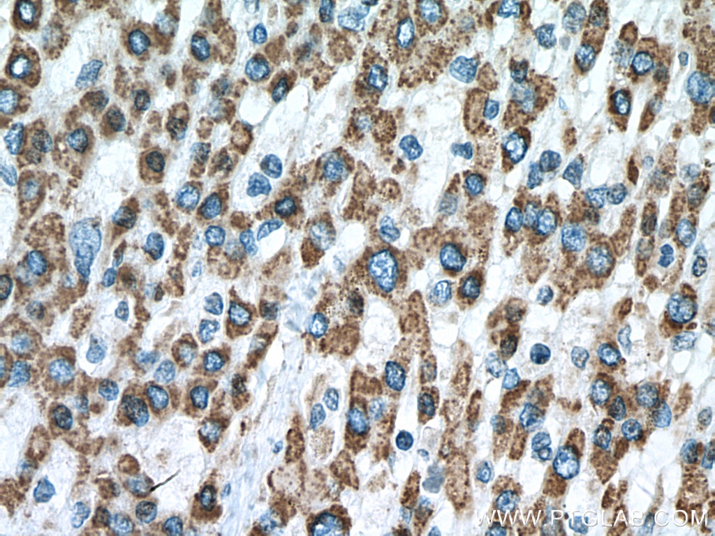 Immunohistochemistry (IHC) staining of human liver cancer tissue using IVD Polyclonal antibody (10822-1-AP)