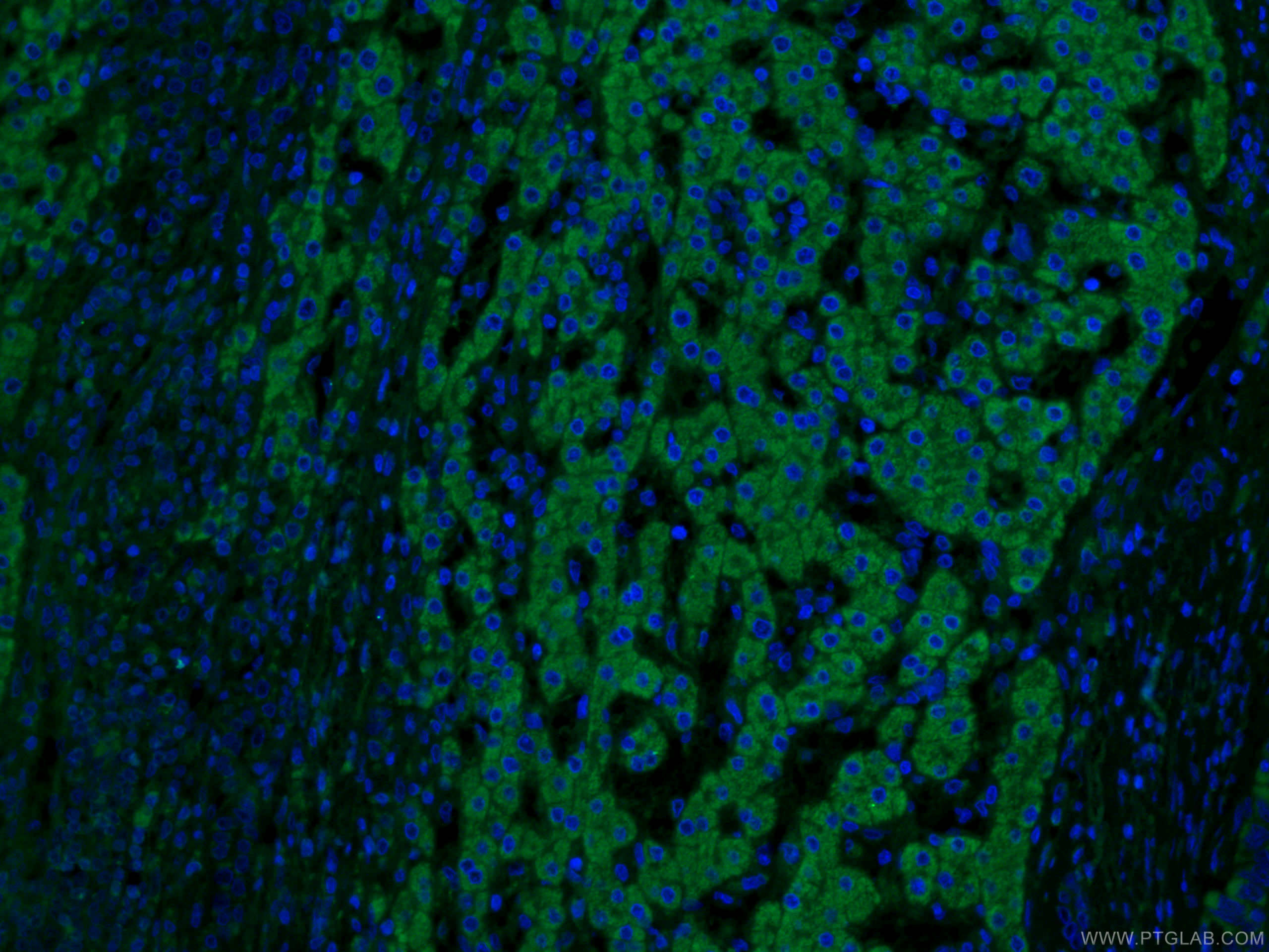 Immunofluorescence (IF) / fluorescent staining of human liver cancer tissue using IVD Monoclonal antibody (66032-1-Ig)