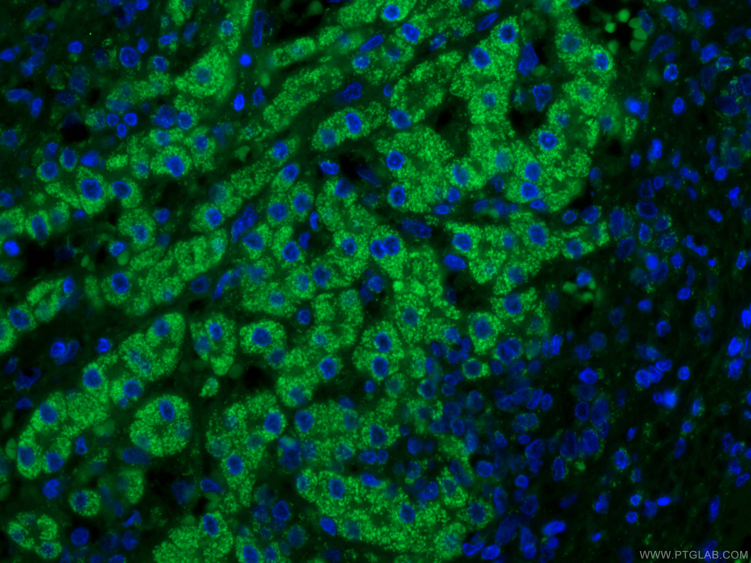 Immunofluorescence (IF) / fluorescent staining of human liver cancer tissue using IVD Monoclonal antibody (66032-1-Ig)