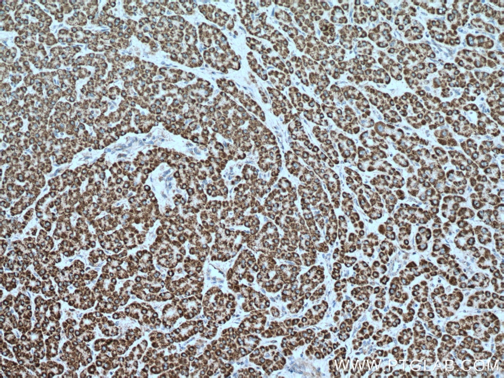 Immunohistochemistry (IHC) staining of human liver cancer tissue using IVD Monoclonal antibody (66032-1-Ig)